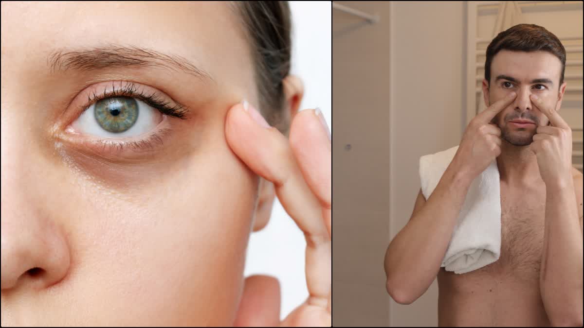 how to remove dark circles under eyes