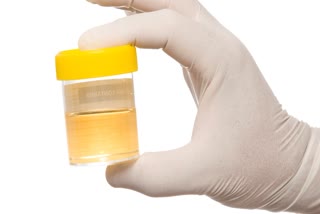 URINE COLOUR AND DISEASE