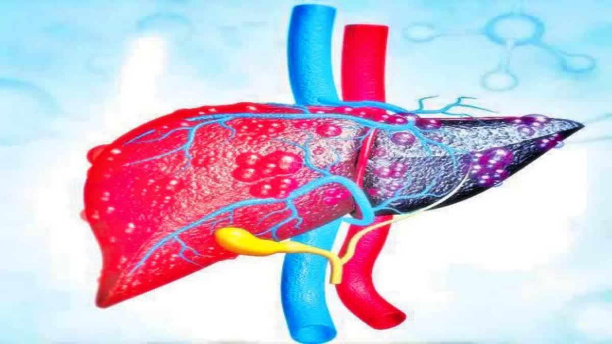 Hepatitis Cases in Konaseema District