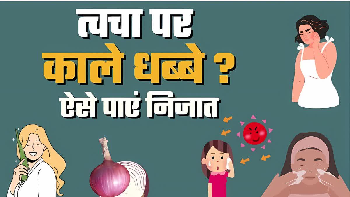 काले धब्बों से निजात पाने के टिप्स