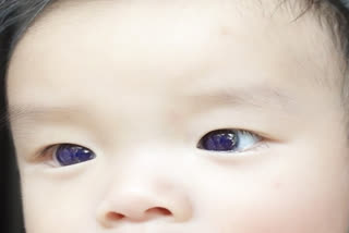 Covid antiviral turns Thai baby's brown eyes blue