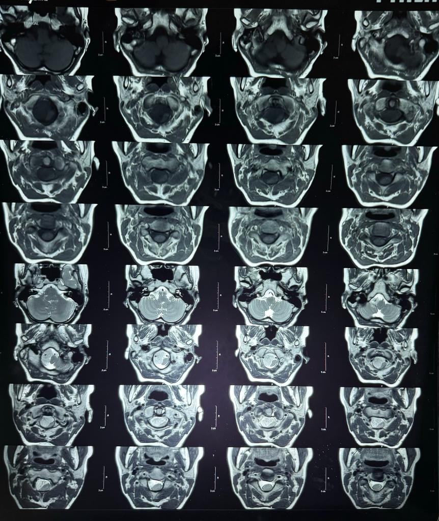 meningioma tumor in Indore patient