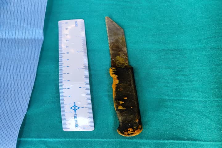 Shocking! 20-cm-long knife found in man's liver; removed