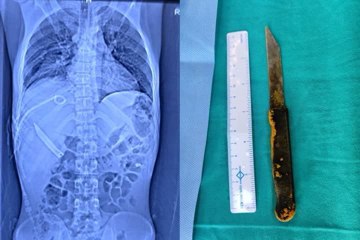 Shocking! 20-cm-long knife found in man's liver; removed