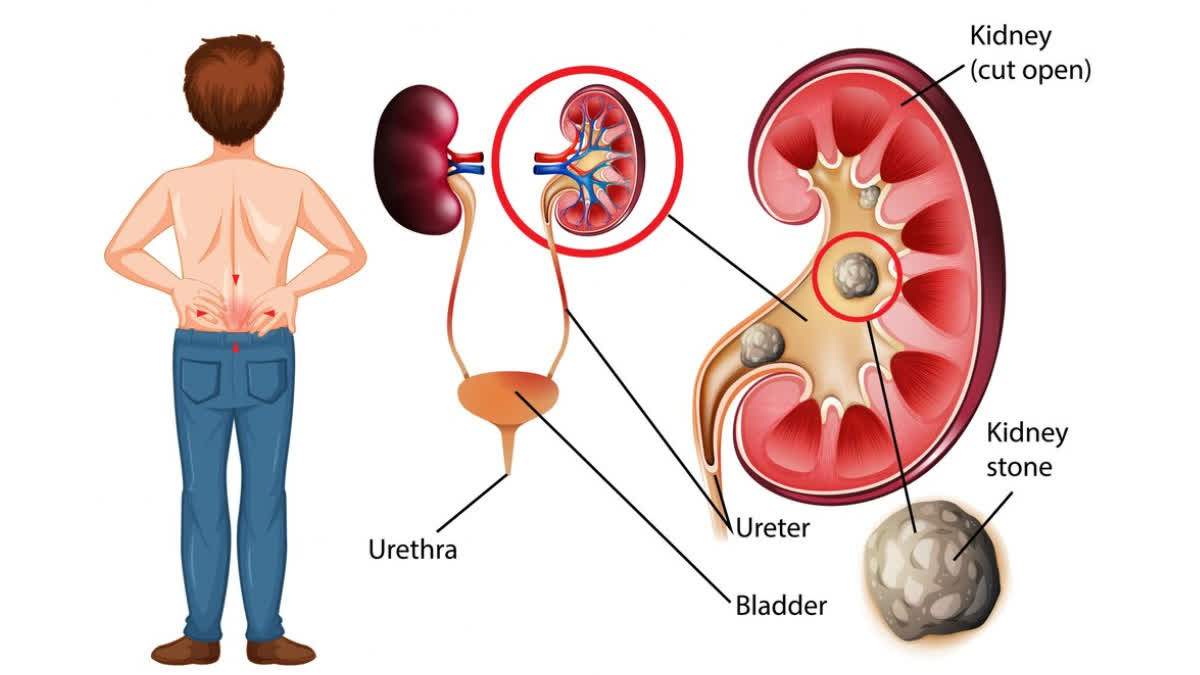 Pain in the lower back, abdomen or side can be a symptom of kidney stone, follow this diet chart, you will get relief