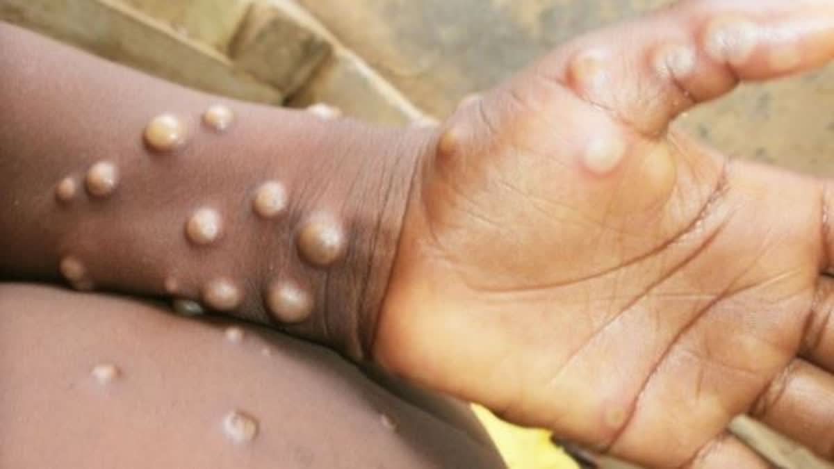 MPOX LATEST UPDATE BY CDC SAYS MPOX NOT SPREAD EASILY THROUGH AIR