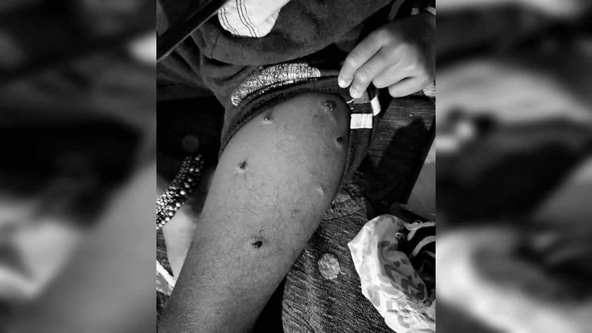 leopard-attacked-girl-in-tumkur-father-rescued-daughter-from-leopard-in-tumkur