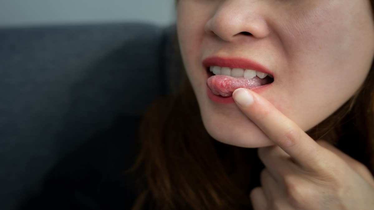 CAN MOUTH ULCERS CAUSE CANCER