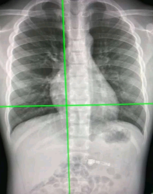 New AI tool can detect Covid infection from chest X-rays 98% accuracy