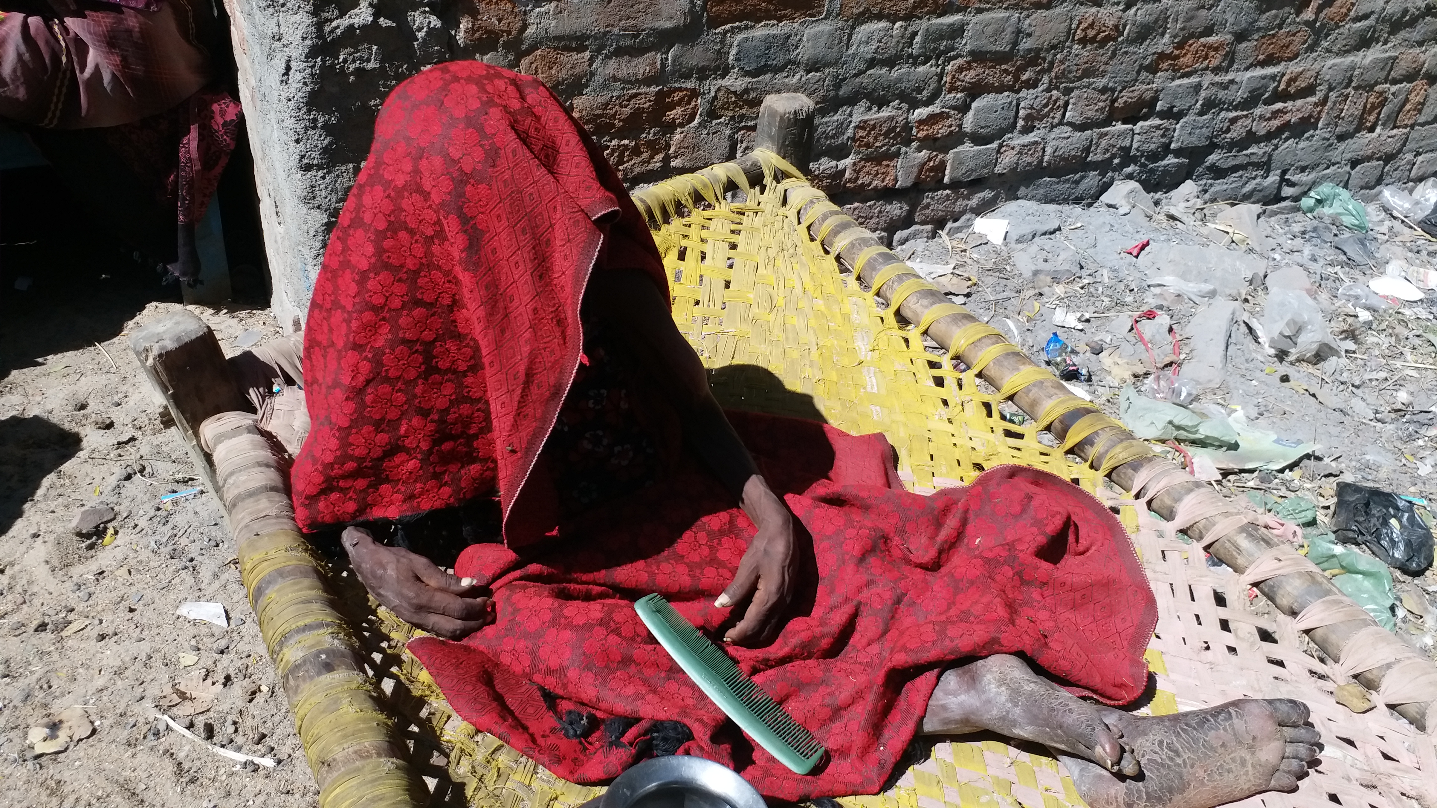 A woman with scars of fluorosis.