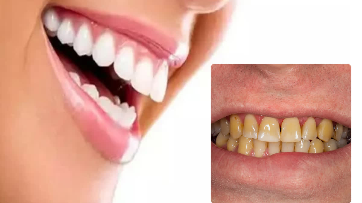 HOME REMEDIES FOR YELLOW TEETH