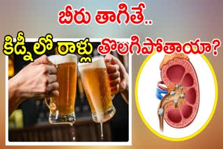 DOES BEER HELPS KIDNEY STONES