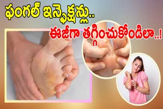 Best Tips To Prevent Fungal Infections