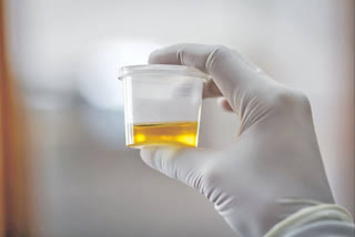a-new-urine-based-test-for-prostate-cancer-with-effectively