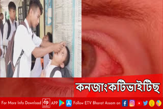 Conjunctivitis out break in Assam