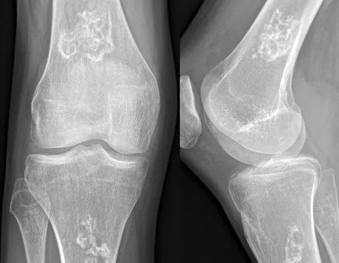 New treatment for osteoarthritis brings hope to patients