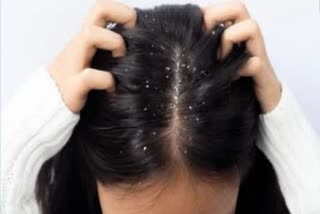 Are you suffered from Dandruff problem? Here is the solution