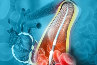 Do Heart Stents Need To Be Replaced Regularly Is It Safe Full Details Here In Telugu