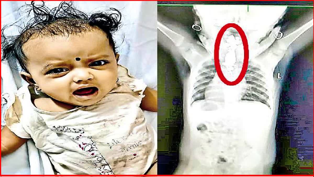 7 Month Old Girl Swallowed Silver Anklet