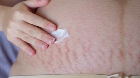 STRETCH MARKS  TIPS TO GET RID OFF STRETCH MARKS  STRETCH MARKS HOME REMEDIES  NATURAL TIPS TO STRETCH MARKS