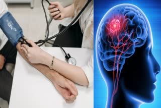 High Blood Pressure Linked to Alzheimer