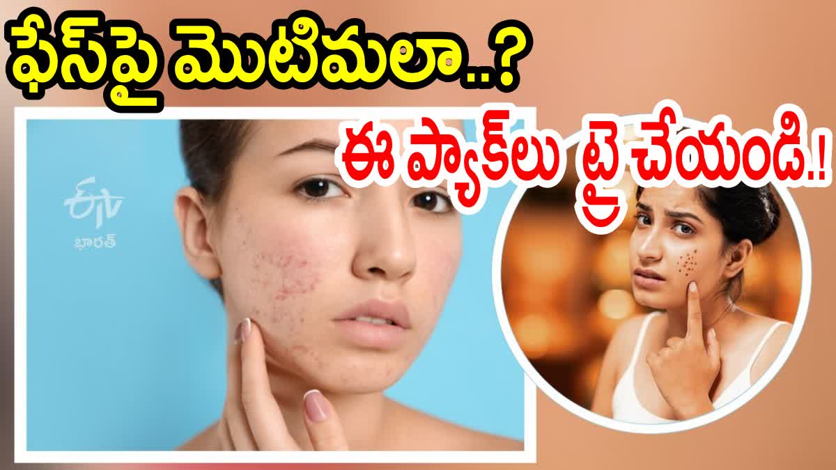 Home Remedies for Pimples and Dark Spots