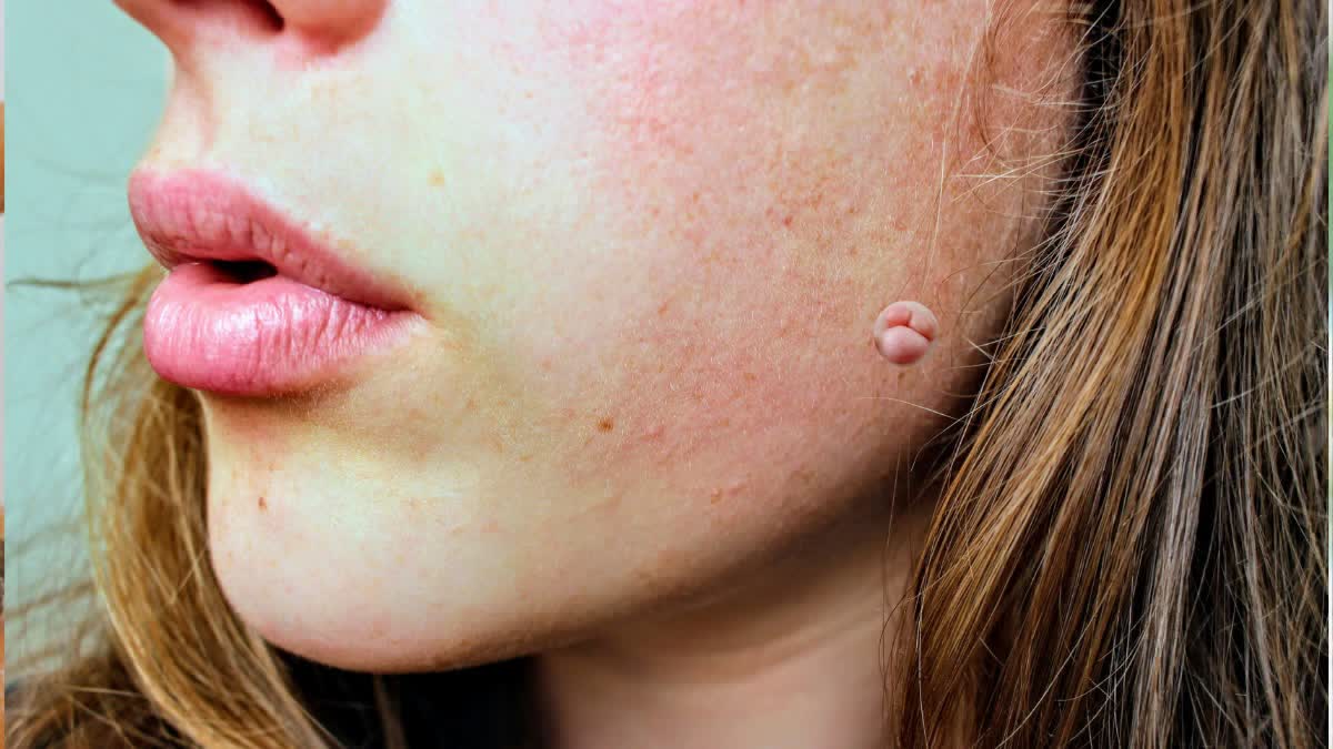 CAUSES OF LUMPS ON THE SKIN