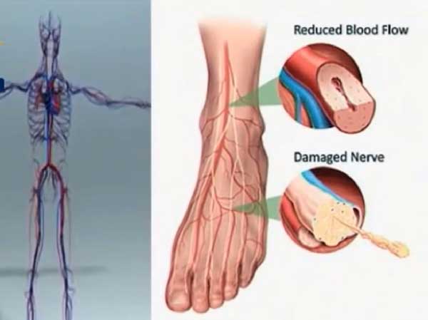 cramps-occurs-due-to-damage-to-the-peripheral-nerves