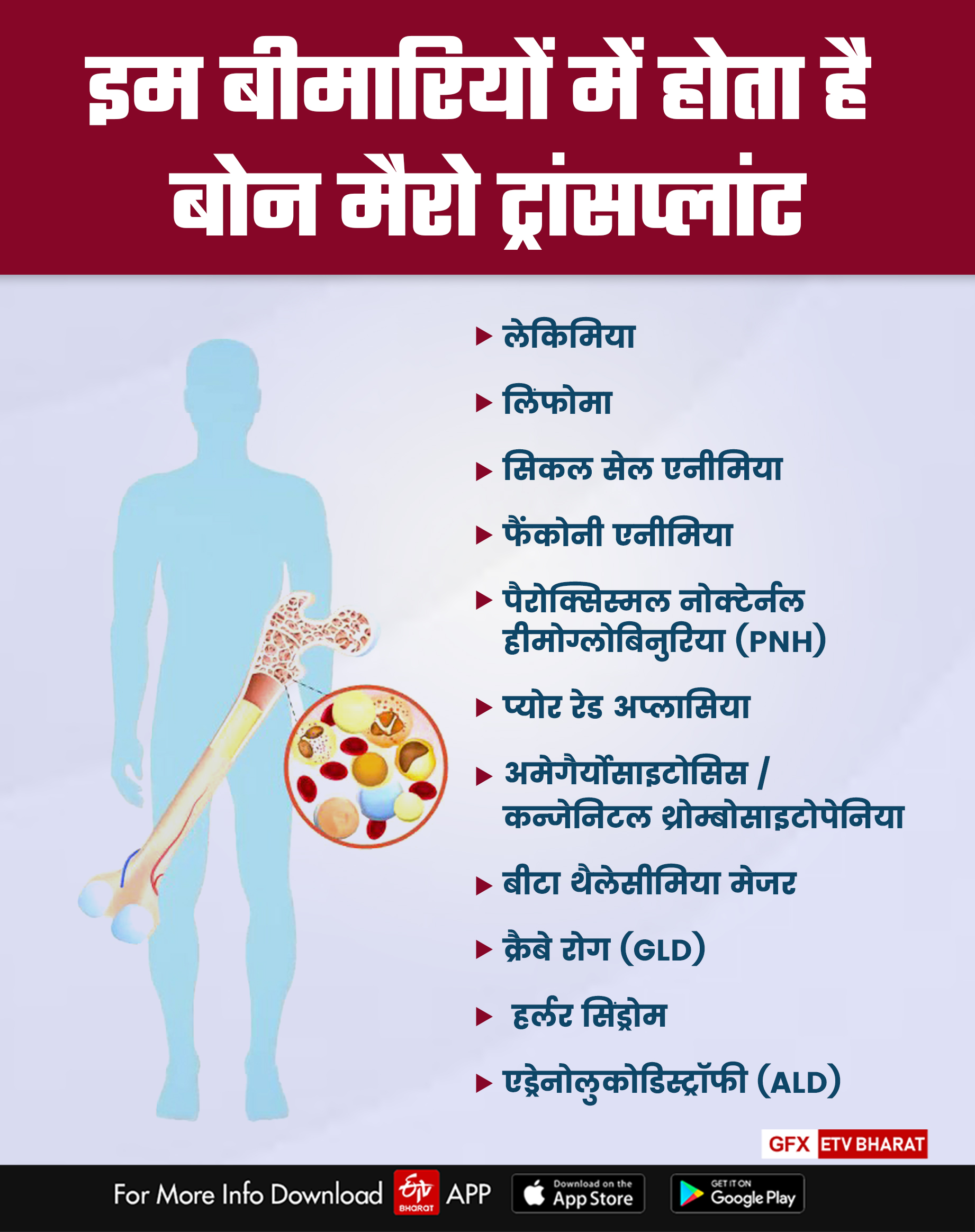 bone marrow transplant