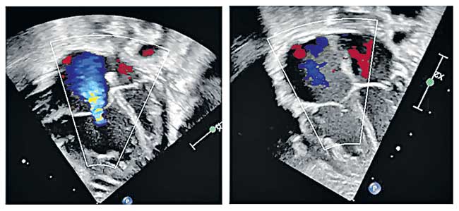 cardiac beriberi