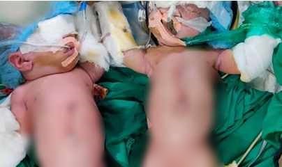 Wadia hospital Conjoined twins separated