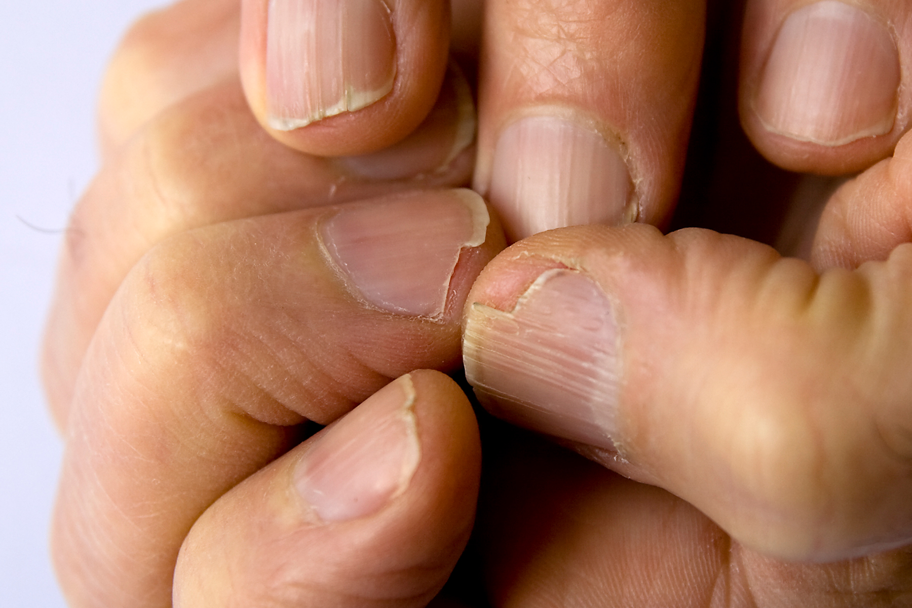 Split or Cracked Nails