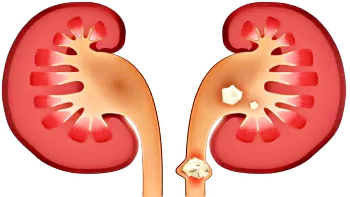 Drinking alkaline water may not prevent kidney stones: Study
