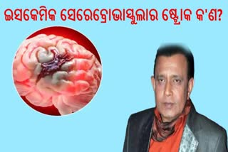 ଇସକେମିକ ସେରେବ୍ରୋଭାସ୍କୁଲାର ଷ୍ଟ୍ରୋକରେ ପୀଡ଼ିତ ମିଥୁନ, ଜାଣନ୍ତୁ ଏହା କ'ଣ?