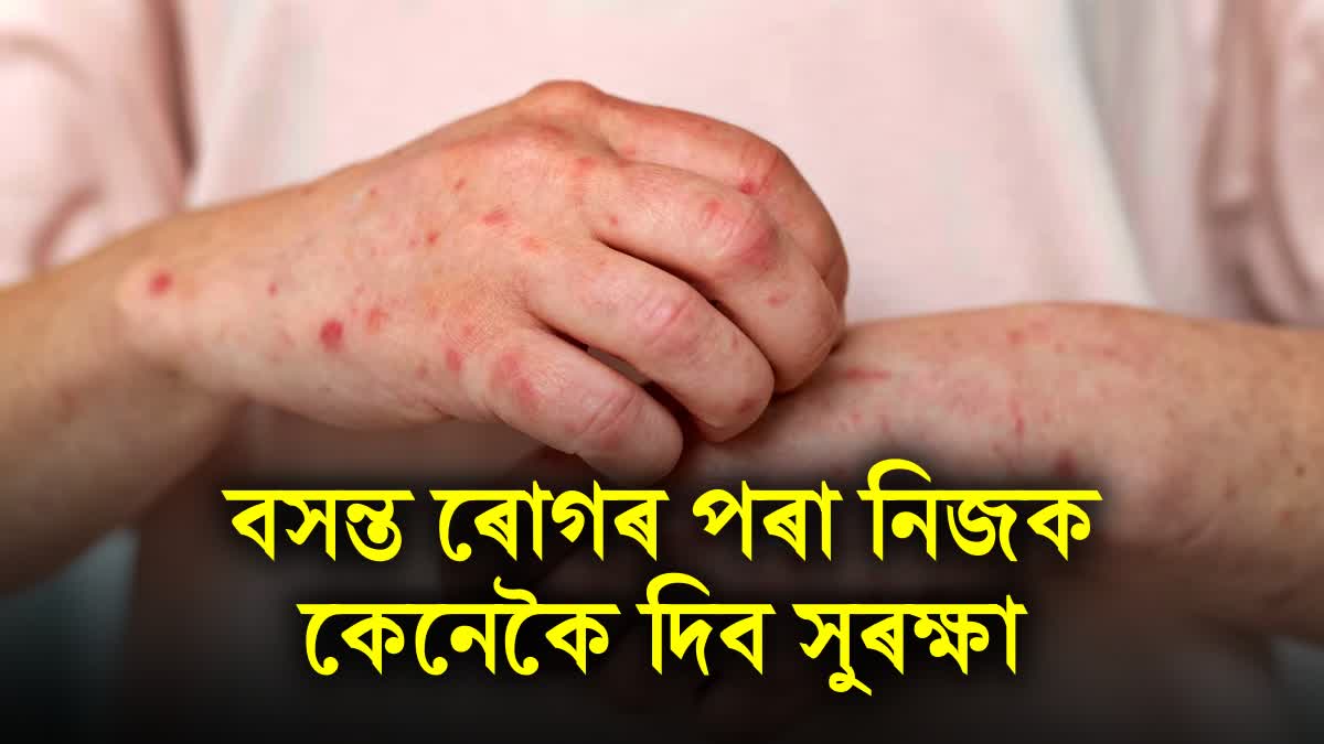 chickenpox-symptoms-causes-and-prevention