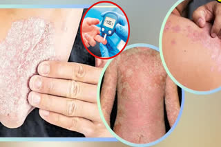Diabetic patients are more prone to skin infections than normal people