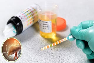 URINE COLOR IN LIVER DISEASE