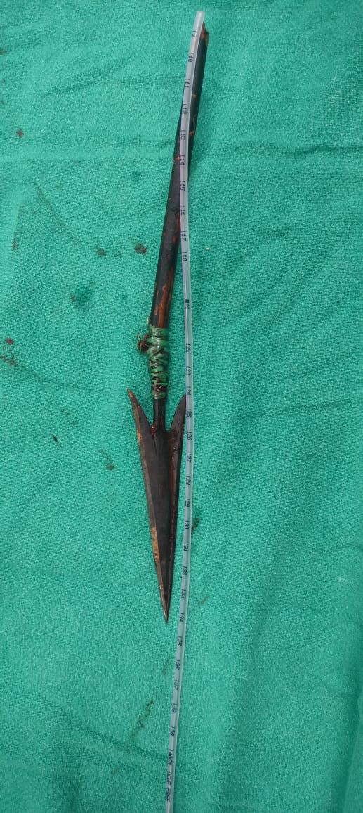 Doctors Remove Arrow Lodged Close To Man's Heart In Odisha