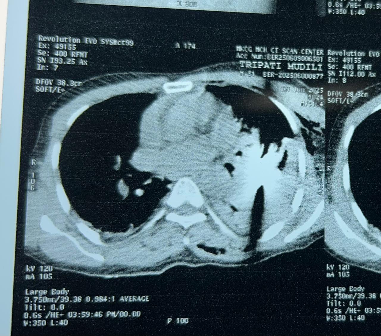Doctors Remove Arrow Lodged Close To Man's Heart In Odisha