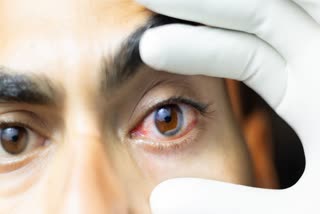Dry Eyes Symptoms and Causes