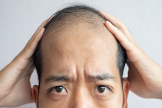 How Androgenetic Alopecia (Pattern Baldness) And How is it Different In Male And Female