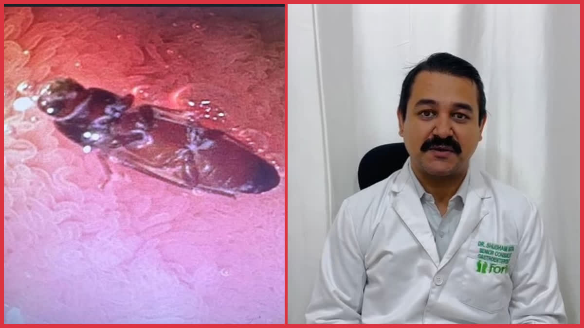 Doctors remove live cockroach from stomach in fortis hospital