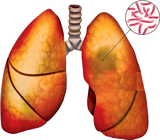 World Tuberculosis Day 2021: