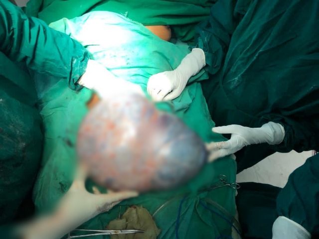 15 kg tumor