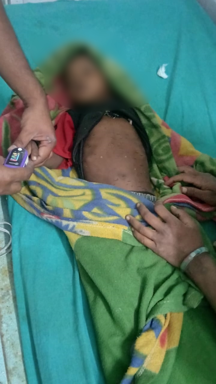 Bhondubaba burn three-year-old boy's stomach in Melghat