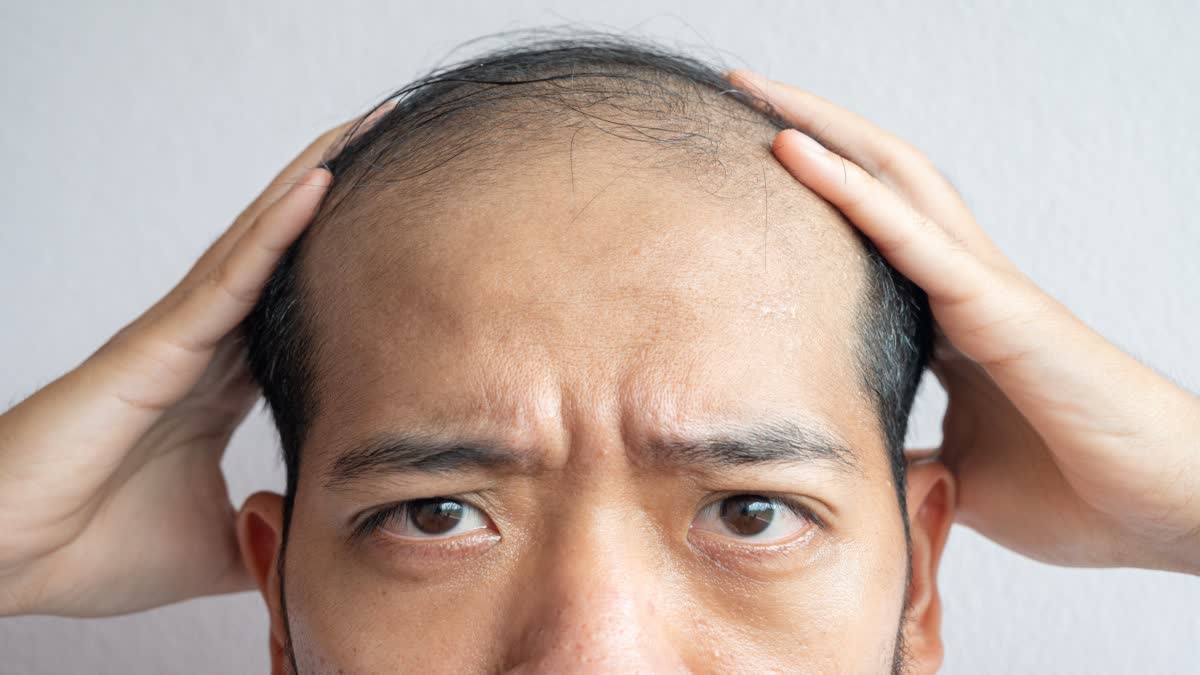 Tips to Prevent Baldness Problem