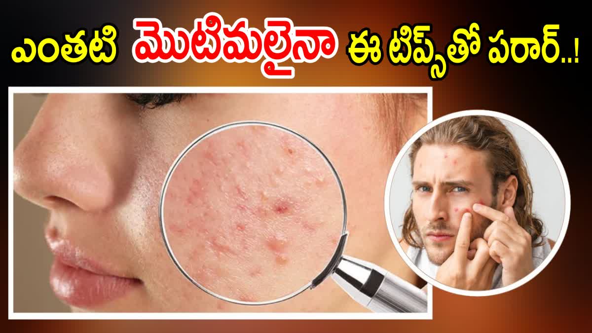 Tips to Avoid Pimples