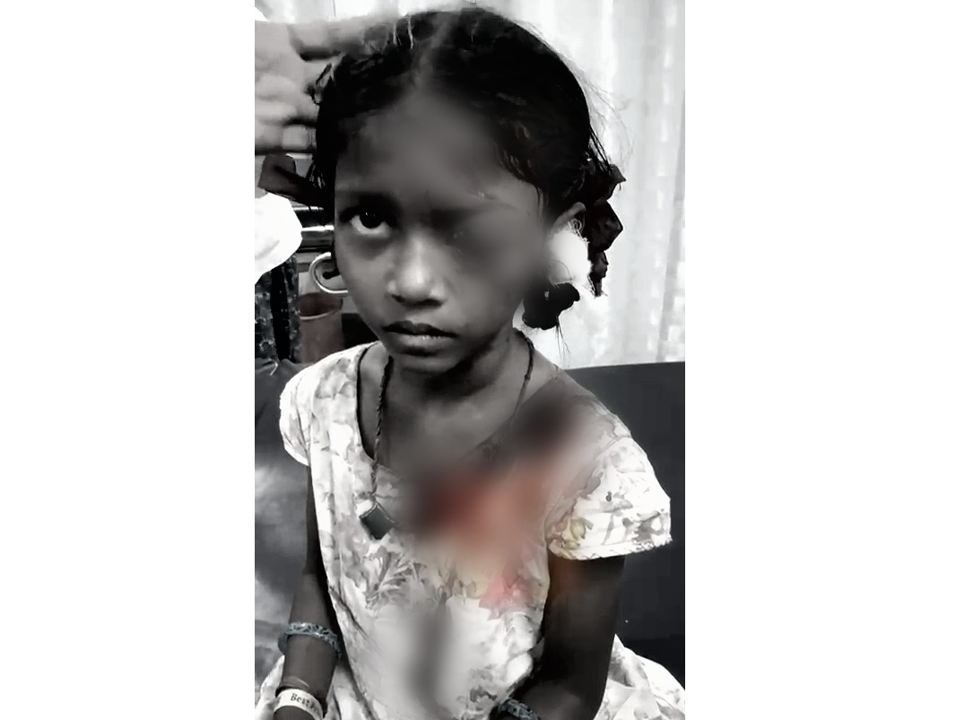 A 9 year old girl, Deepali, was seriously injured in an attack by stray dogs in Gulbarga district