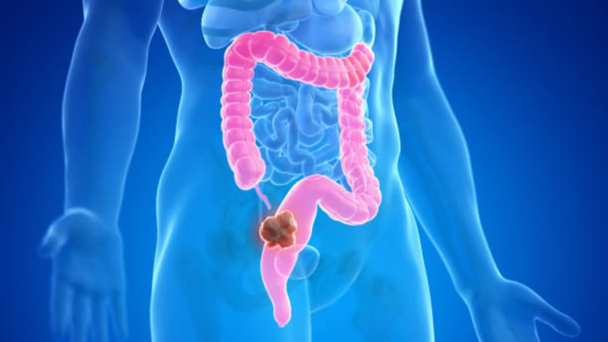 Colorectal Cancer