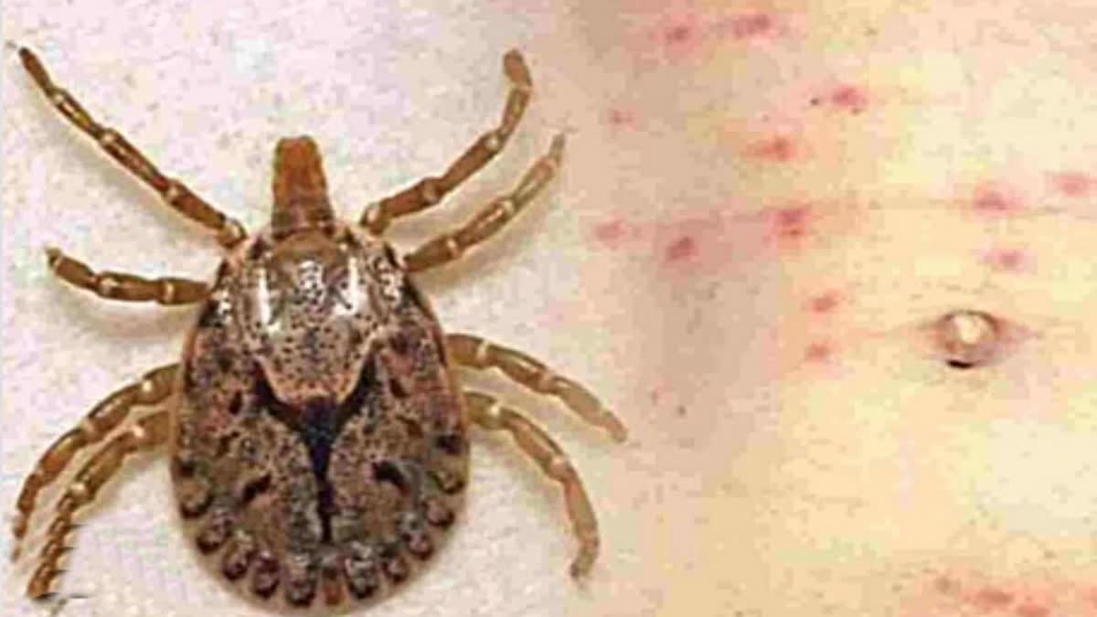 suspected patients of scrub typhus in Jharkhand
